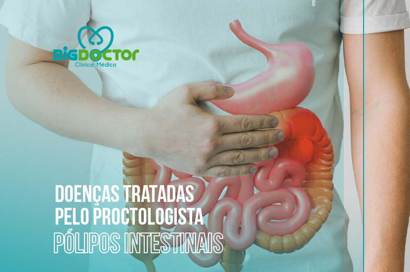 Doenças tratadas pelo Proctologista: Pólipos intestinais
