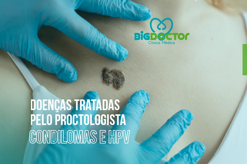 Doenças tratadas pelo proctologista: Condilomas e HPV