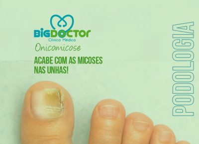 Acabe com as Micoses nas Unhas!