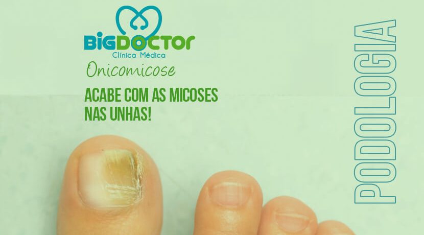 Acabe com as Micoses nas Unhas!