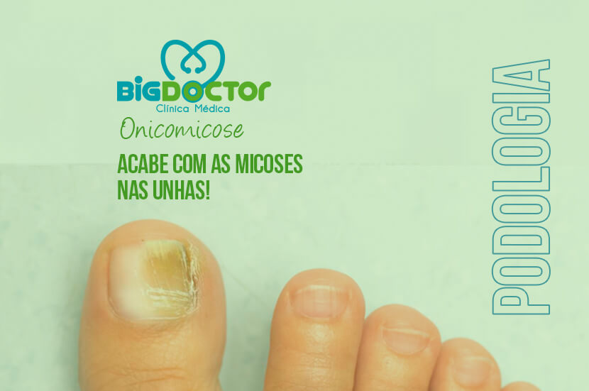 Acabe com as Micoses nas Unhas!