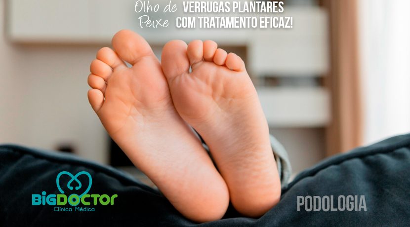 Olho de verruga plantares, Peixe com tratamento eficaz!