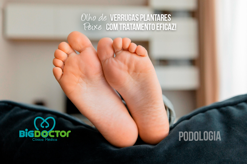 Olho de verruga plantares, Peixe com tratamento eficaz!
