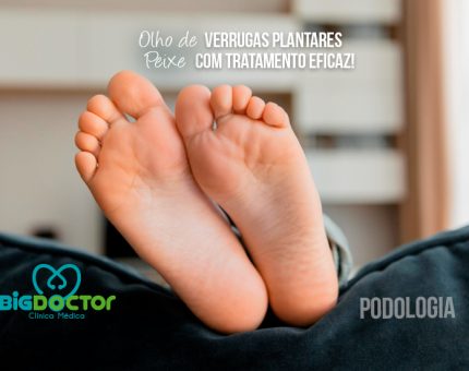 Olho de Peixe, Verrugas Plantares com Tratamento Eficaz!